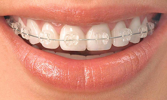 Short-Term Orthodontics: Key Considerations for General Dental Practitioners - Dental Valution