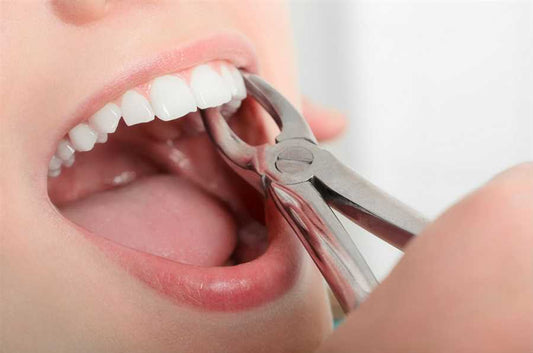 Case Study: Managing Complications During Tooth Extraction - Dental Valution