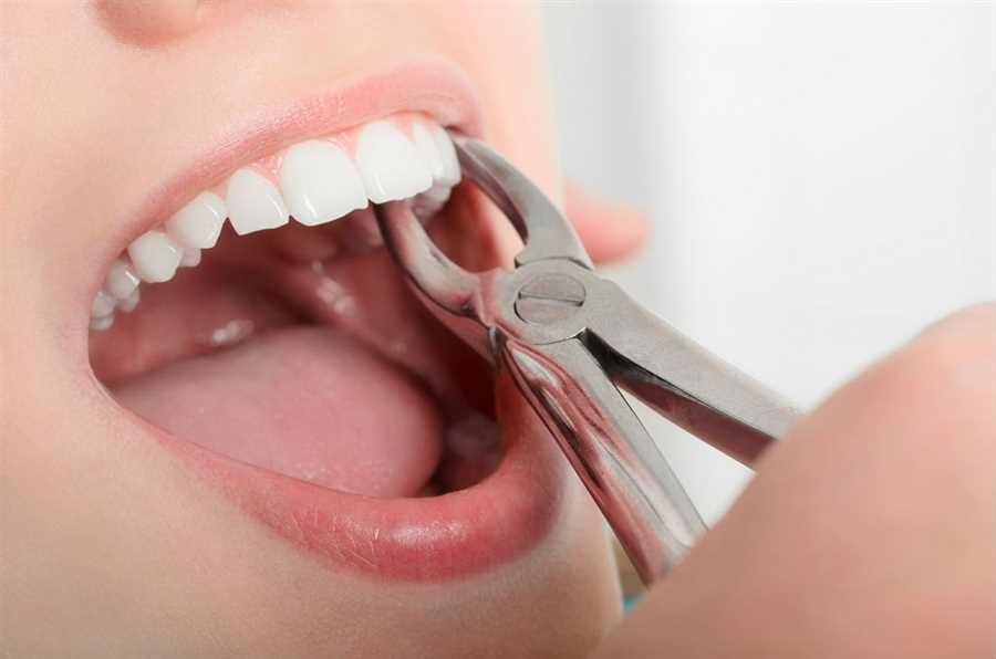 Case Study: Managing Complications During Tooth Extraction - Dental Valution