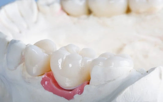 Advancing Dental Crown Restorations: Innovative Composite Materials in Just 35 Minutes - Dental Valution