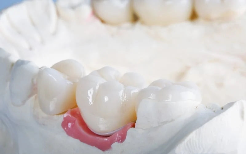 Advancing Dental Crown Restorations: Innovative Composite Materials in Just 35 Minutes - Dental Valution