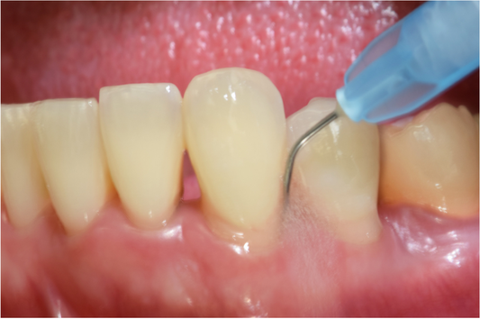 Embracing Innovation in Periodontal Care: From Aussie Culture to Breakthrough Dental Treatments