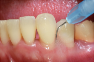 Embracing Innovation in Periodontal Care: From Aussie Culture to Breakthrough Dental Treatments - Dental Valution