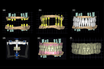 Benefits of Using Digital Workflow in Full Arch Implant Procedures