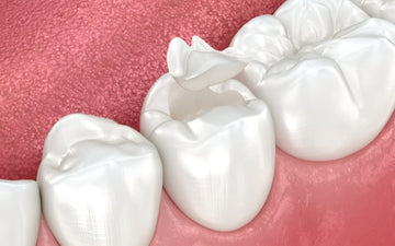 Silver Diamine Fluoride (SDF): A Cost-Effective Solution for Tooth Decay