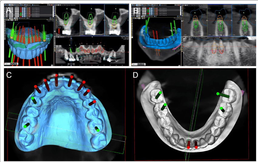 Advancements in Imaging Technologies: The Impact of 3D Imaging on Implant Planning