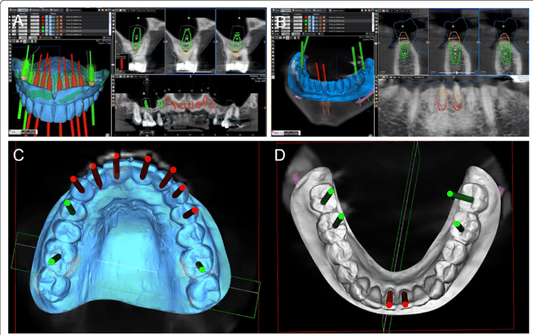 Advancements in Imaging Technologies: The Impact of 3D Imaging on Implant Planning