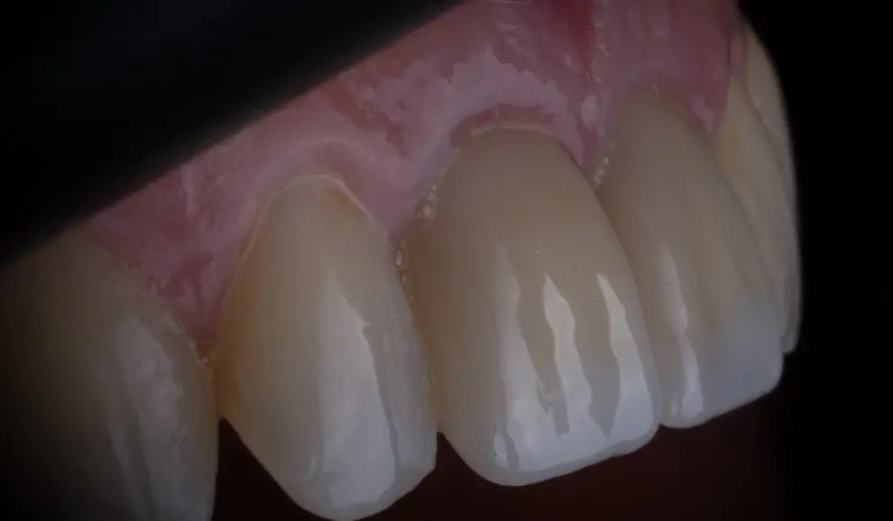 The Evolution of Zirconia in Modern Dentistry: A Case Study - Dental Valution