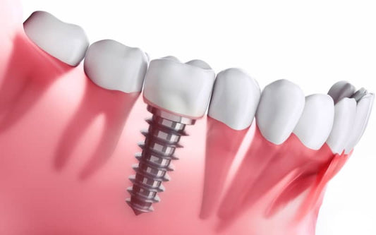 From Stem Cells to Dental Implants: Pioneering Bone Regeneration in Modern Dentistry