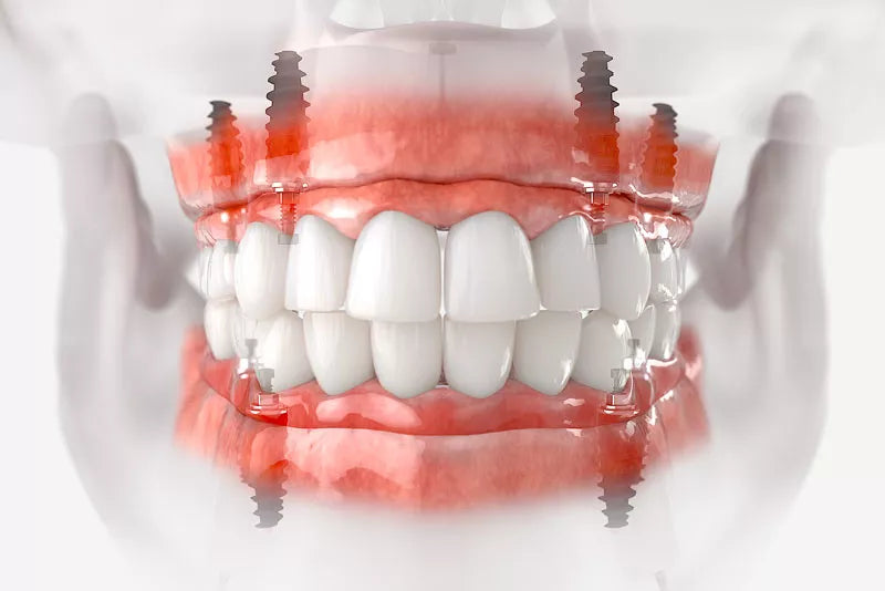 Post-Operative Care for Full Arch Solutions: What Patients Need to Know - Dental Valution