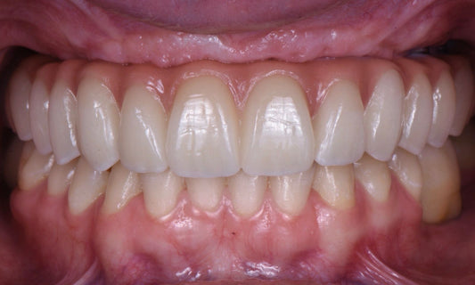 Dental Implant Rehabilitation in Young Patients with Severe Bone Loss: A Case Report - Dental Valution