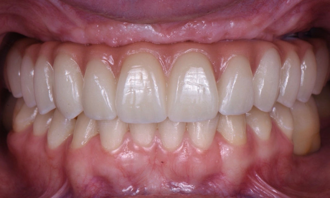 Dental Implant Rehabilitation in Young Patients with Severe Bone Loss: A Case Report - Dental Valution