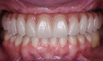 Dental Implant Rehabilitation in Young Patients with Severe Bone Loss: A Case Report - Dental Valution