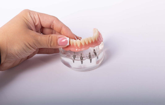 Dental Implants or Dentures: Which is Right for You? - Dental Valution