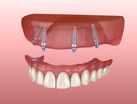 Understanding Full Arch Dental Implants: A Comprehensive Guide