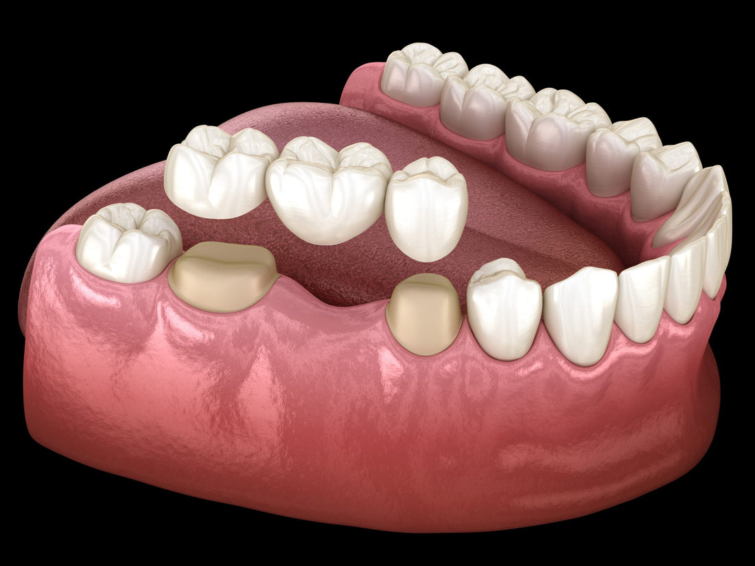 Indirect Restorations: Minimizing Complaints and Claims in Dental Practice