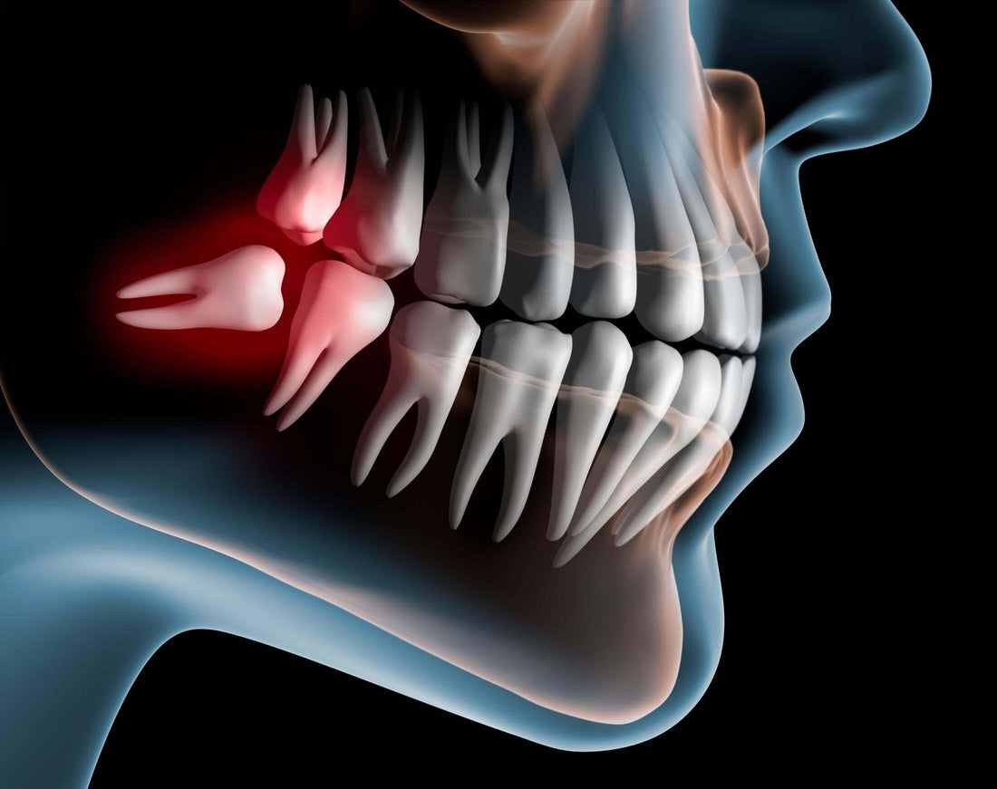 Wisdom Teeth Extraction: What to Expect and How to Prepare Like a Pro! - Dental Valution